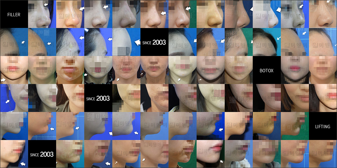 SINCE 2003 MI&MI, 시술후사진모음
